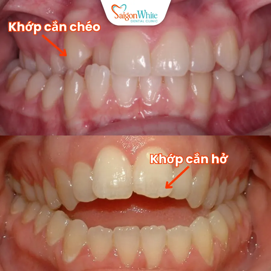 khop can sai_11zon