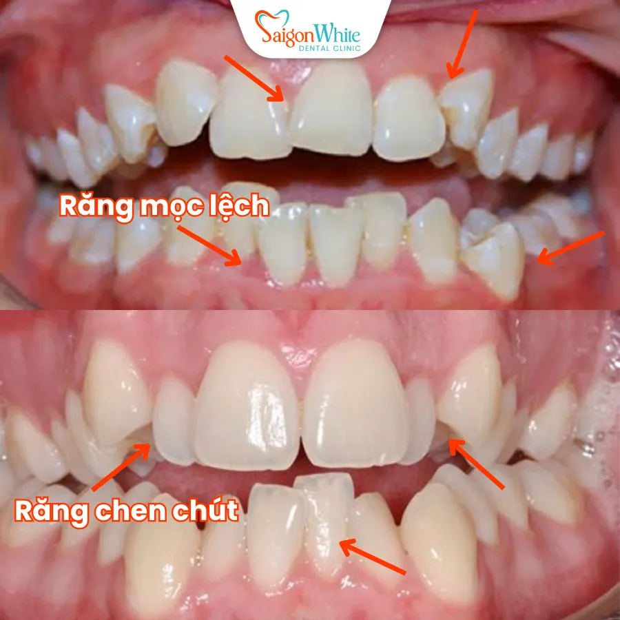 rang moc lech lac chen chut_11zon