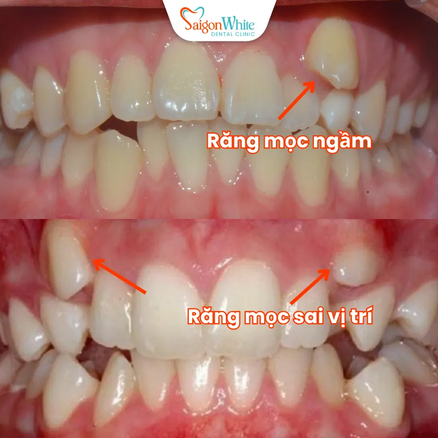 rang moc ngan, moc sai vi tri_11zon